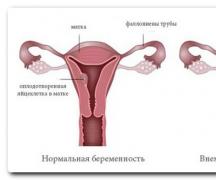 Видна ли внематочная беременность на УЗИ?